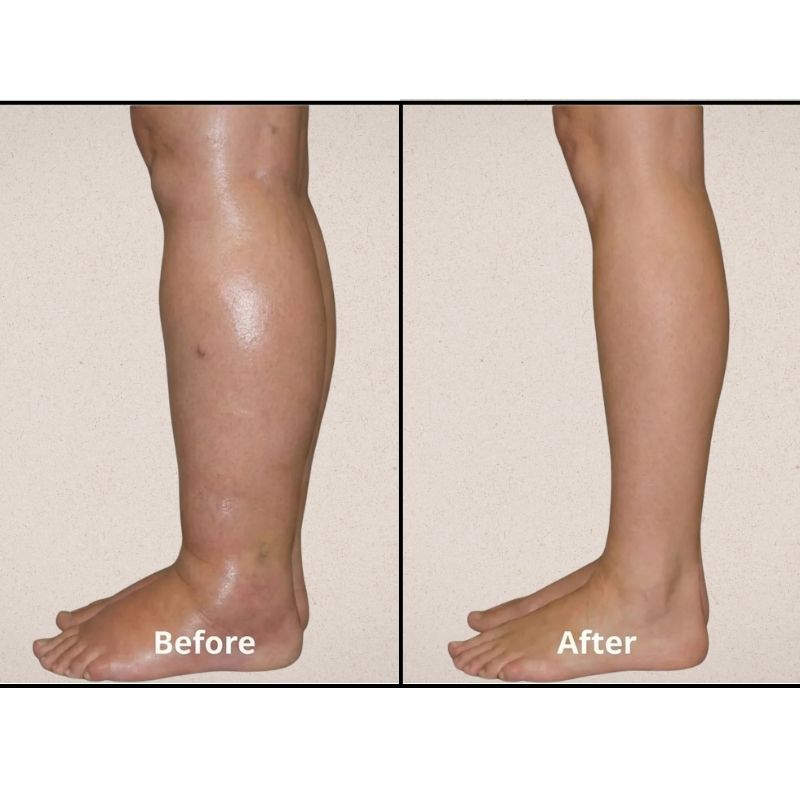 VALERON - EMS TREAT STASIS DERMATITIS FROM HOME