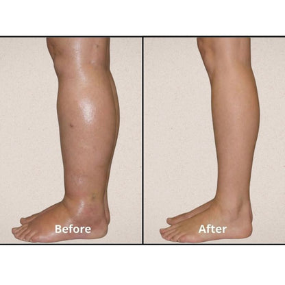 VALERON - EMS TREAT STASIS DERMATITIS FROM HOME
